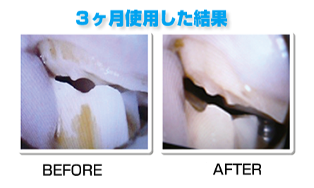 3ヶ月使用した結果の歯の状態